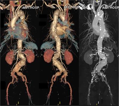 Quadruple fenestration aortic stent implantation combined with unilateral IBE and internal iliac artery stent implantation for complex abdominal aortic aneurysm: one case report